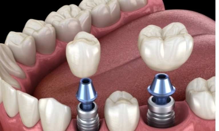 All-on-X Dental Implants Explained: Benefits, Process, and Recovery